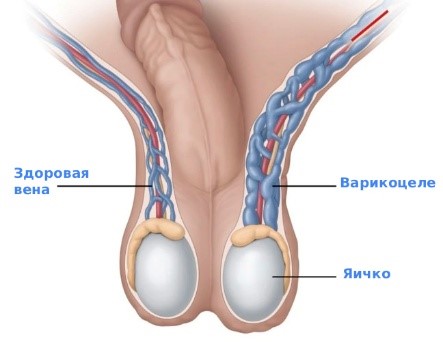 Варикоцеле