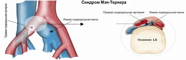 Синдром Мей-Тёрнера