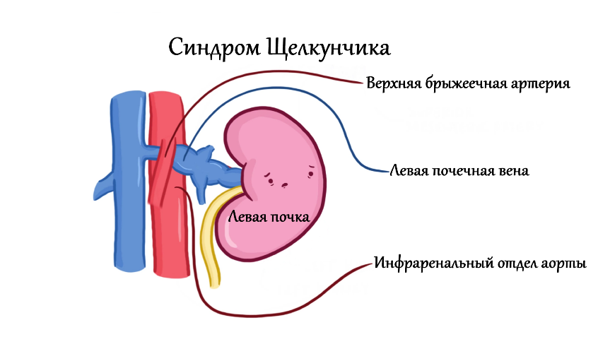 Синдром щелкунчика
