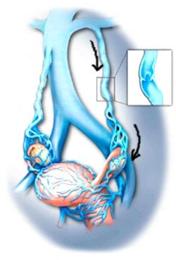 Тазовый варикоз