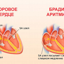 Брадиаритмии. Причины. Показания к имплантации экс